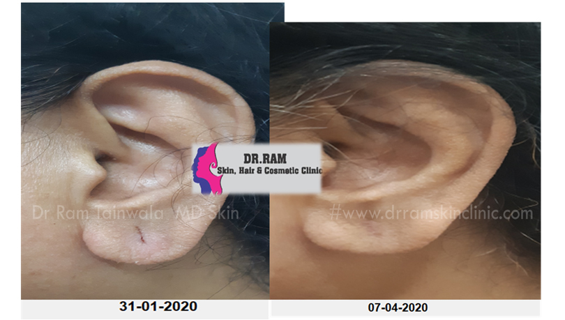 Ear lobe repair