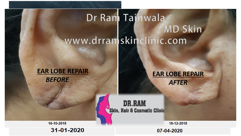 Ear lobe repair