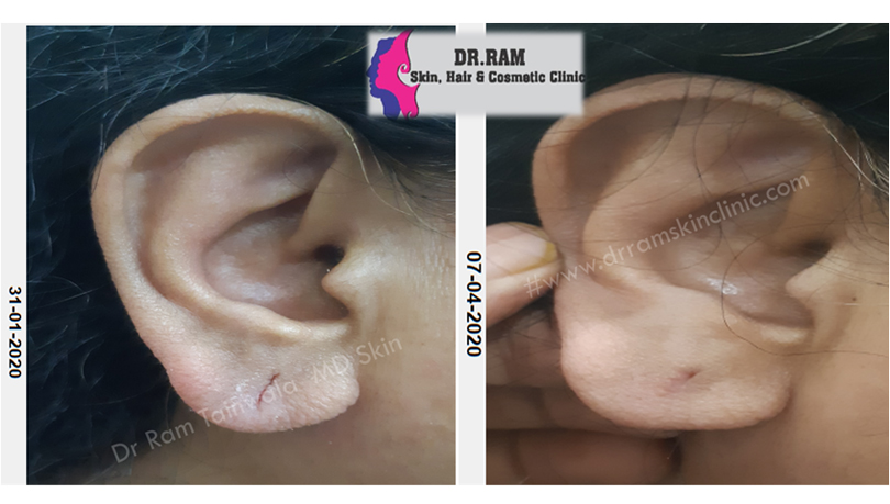 Ear lobe repair