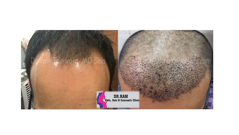 Hair Transplant