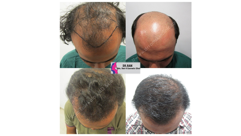 Hair Transplant