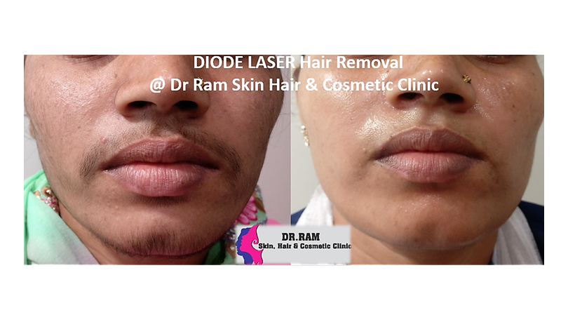 Diode laser hair reduction