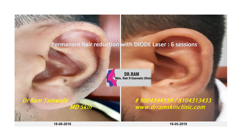 Diode laser hair reduction