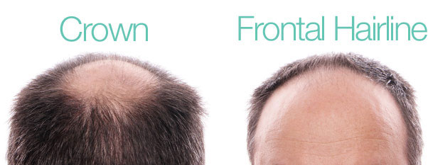 Hair Thinning/Balding For Men