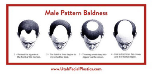 Hair Thinning/Balding For Men