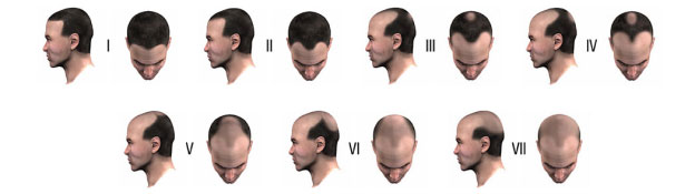 Hair Thinning/Balding For Men