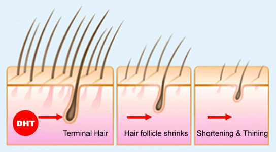 Hair Thinning/Balding