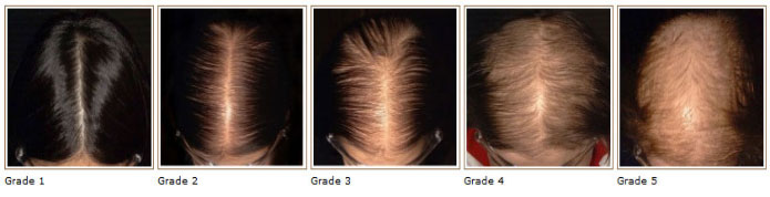 Hair Thinning/Balding For Women