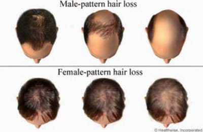 Hair Thinning/Balding For Women