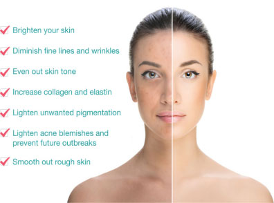 Chemical Peels