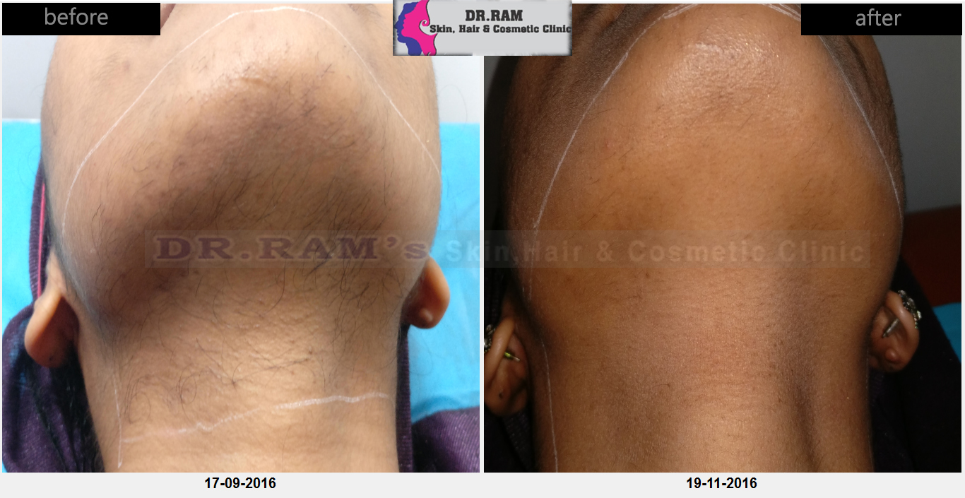 Hair Removal, Laser Hair Removal Treatment, Skin Laser Treatment, Mumbai,  India