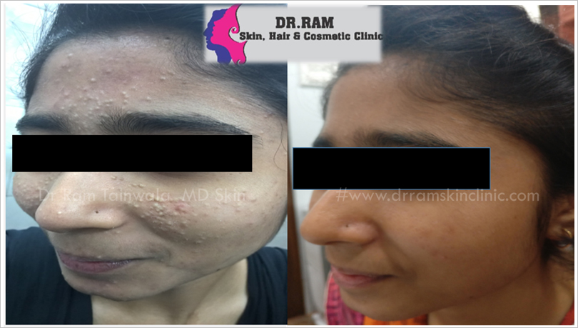 Acne Management treatment result