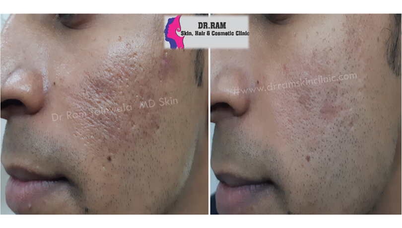Acne Scars treatment result
