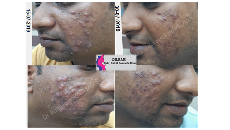 Bacterial Skin Infections treatment result