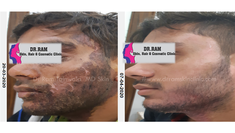 Burns treatment result