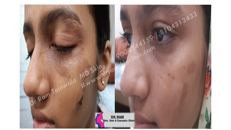 Burns treatment result