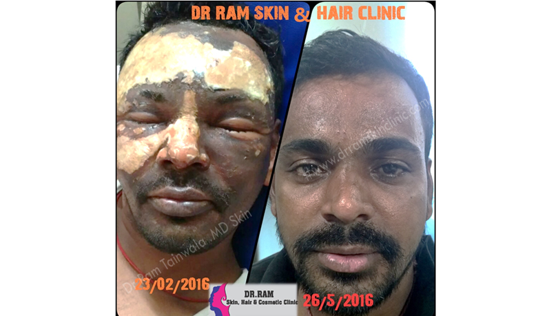 Burns treatment result