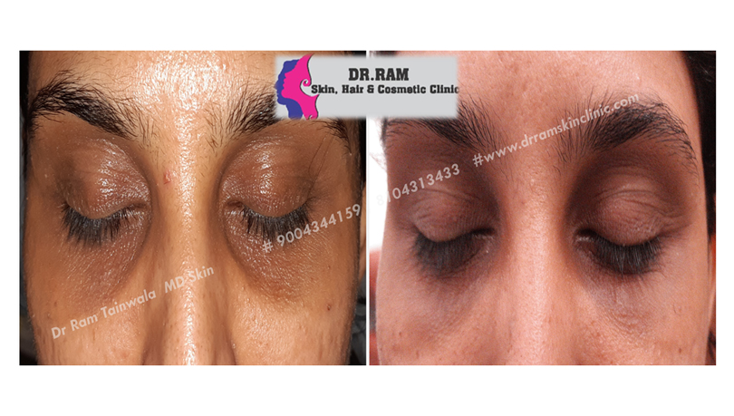 Dark Circles treatment result