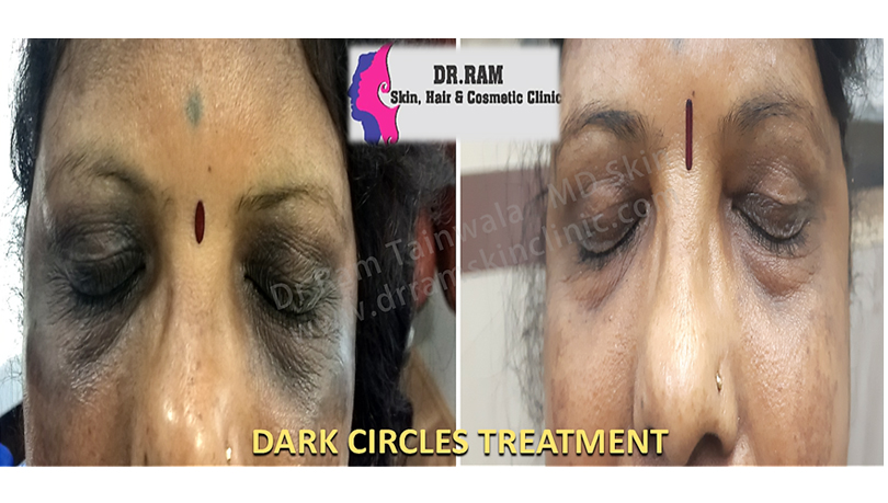 Dark Circles treatment result