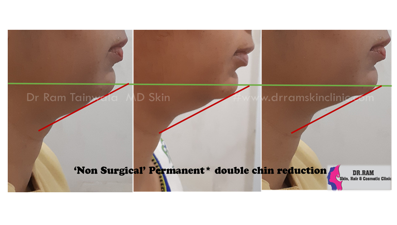 Double Chin Reduction treatment result
