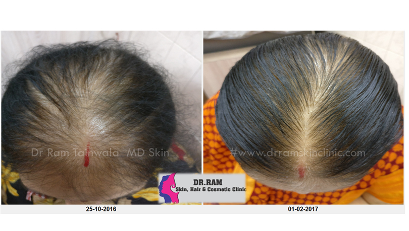 Female Balding treatment result