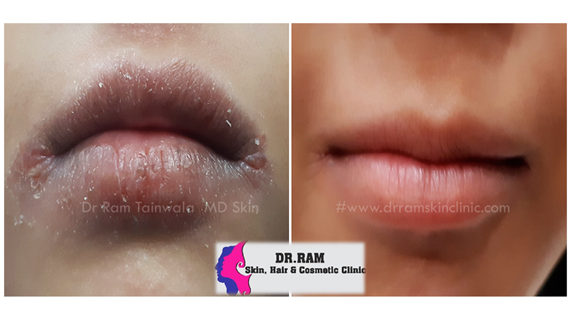 Lips treatment result