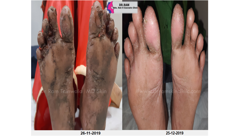 Wart Removal & Growths treatment result