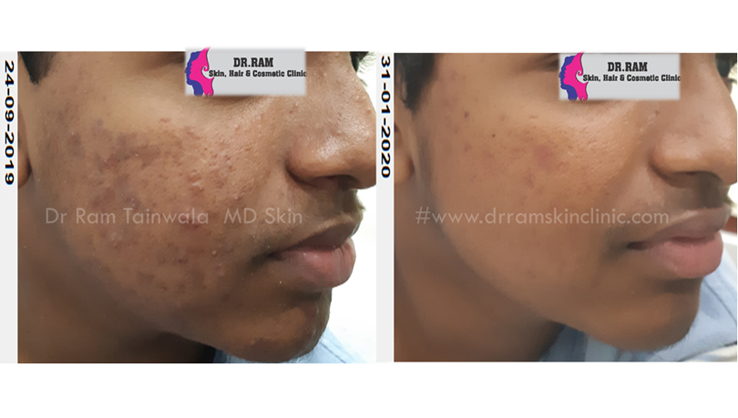 Pigmentation treatment result