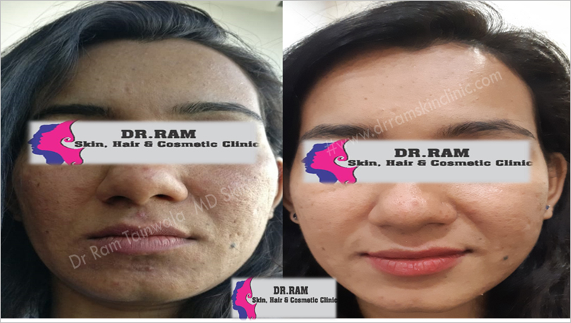 Skin Glow treatment result