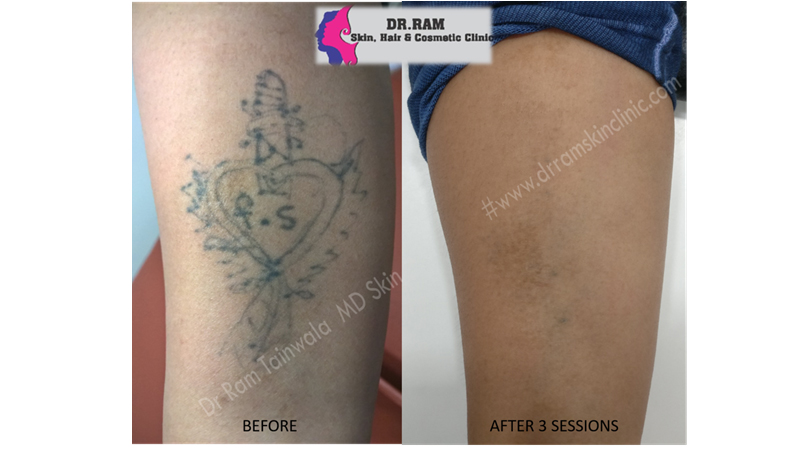 Tattoo Removal treatment result