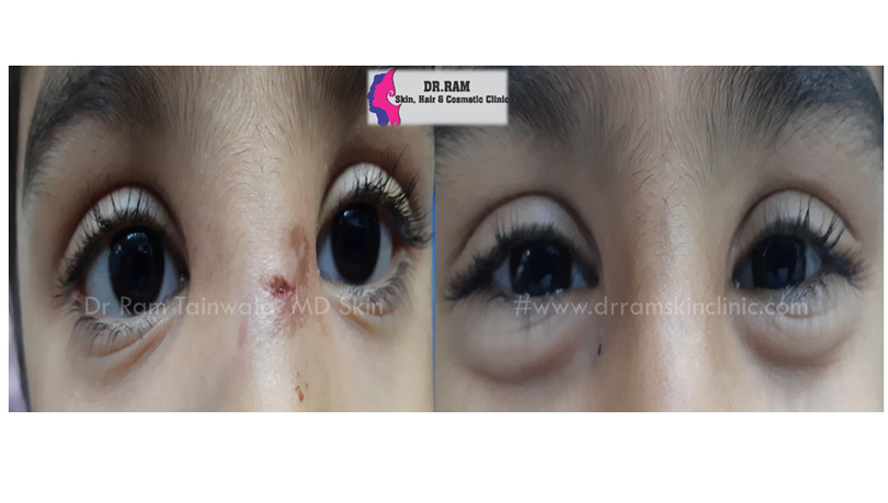 Trauma treatment result