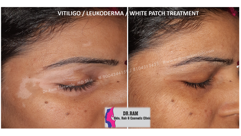 Vitiligo treatment result