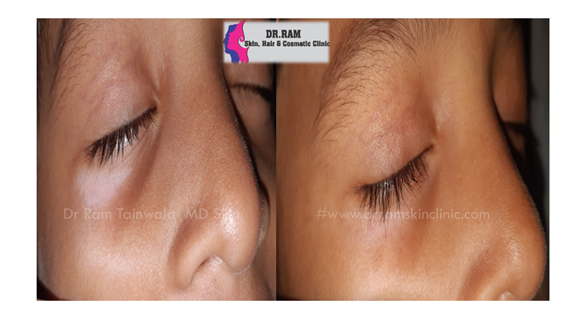 Vitiligo treatment result