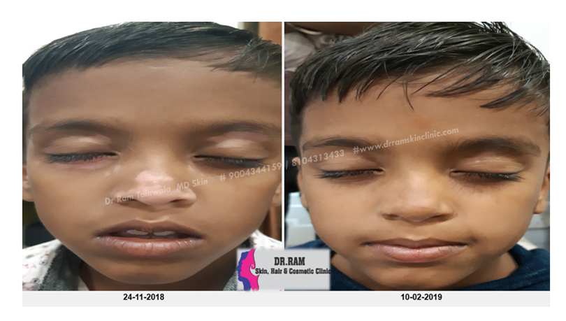 Vitiligo treatment result