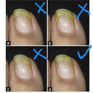 Nail'd The Toe: Onychocryptosis