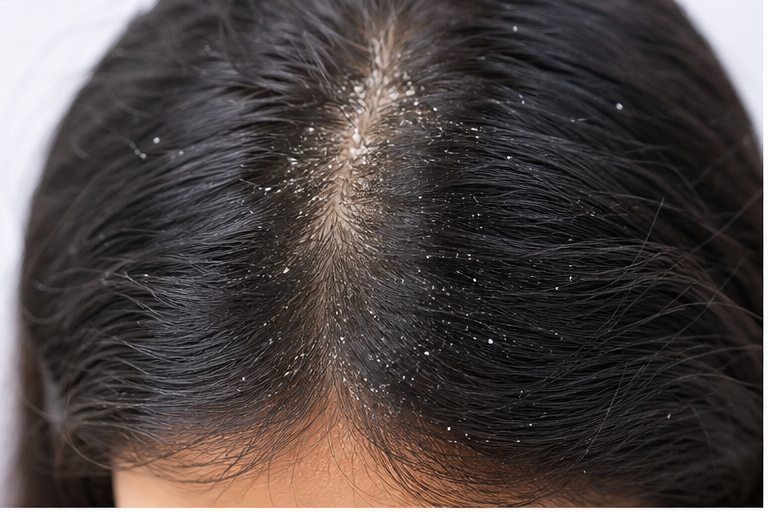 Dry Scalp Flaking