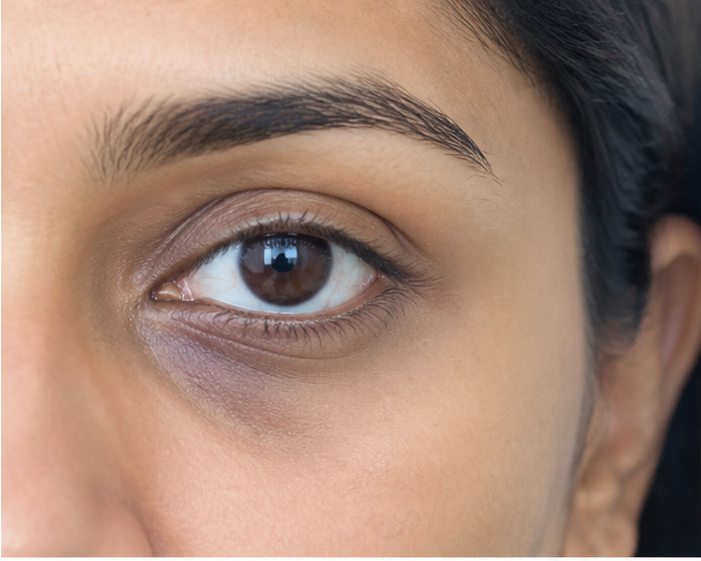 Vascular Dark Circles