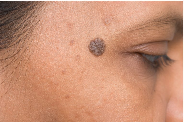 Seborrheic Keratosis & DPNs
