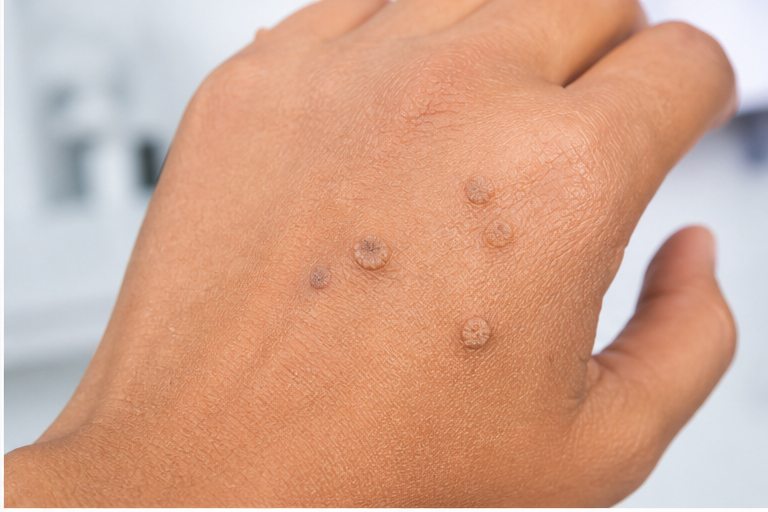 Viral Warts (Verrucae)