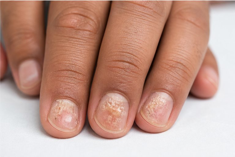 Nail Psoriasis