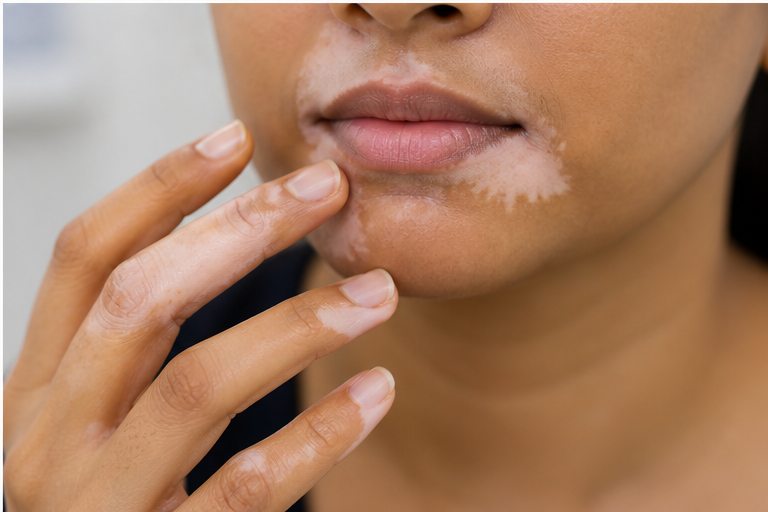 Acrofacial Vitiligo